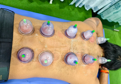 Cupping Therapy at PAL Physiotherapy Madhapur